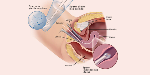 intrauterine-insemination