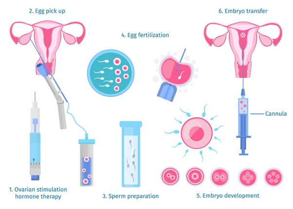 In Vitro Fertilization